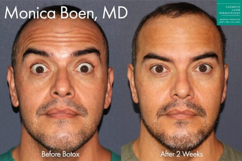 cosmetic laser dermatology Botox wrinkle treatment before and after results in San Diego ca