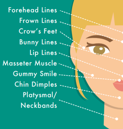 Dysport treatment area diagram from Cosmetic Laser Dermatology in San Diego