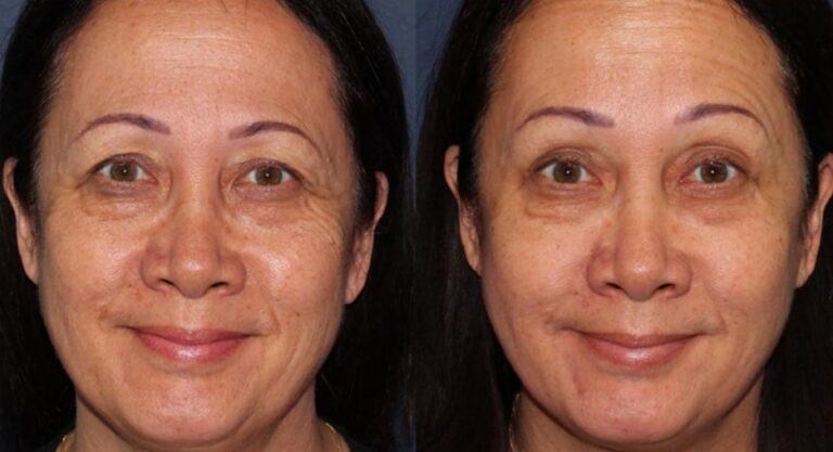 Before and after front image of Botox treatment on a female's crow's feet performed by Dr. Butterwick at our San Diego medi spa