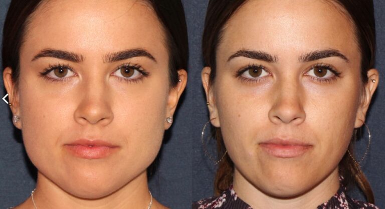 Before and after front image of Botox treatment on a female's masseter muscles performed by Dr. Groff at our San Diego medi spa