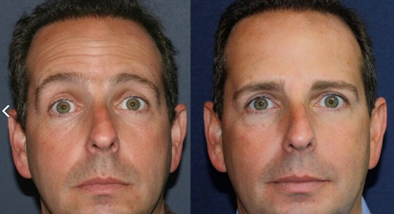 Before and after front image of Botox treatment on a male's forehead lines performed by Dr. Groff at our San Diego medi spa