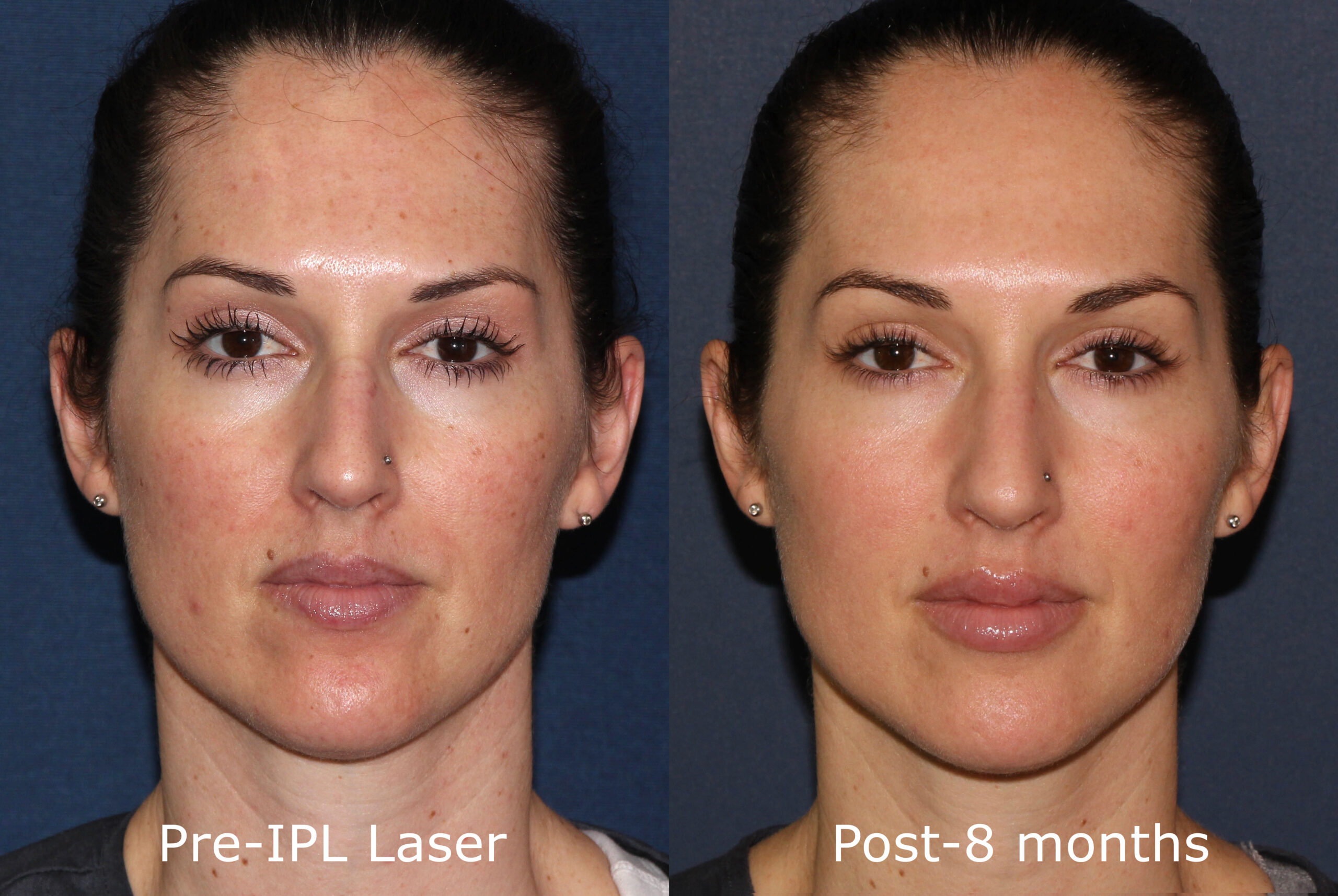 How Laser Skin Tightening Works - Radiofrequency Skin Treatment Details