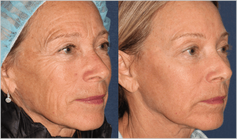 Before and after oblique image of Fraxel Re:pair treatment on a female's face performed by Dr. Fabi at our San Diego medi spa
