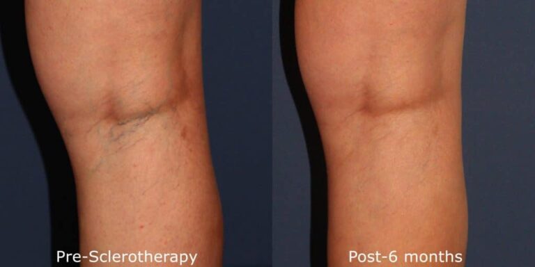Before and after back image of sclerotherapy treatment on a female's knee veins performed by Dr. Goldman at our San Diego med spa