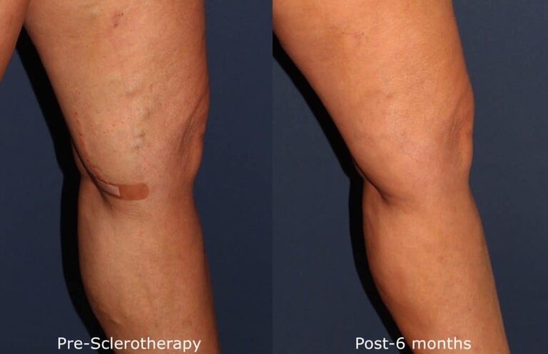 Before and after side image of sclerotherapy treatment on a female's leg veins performed by Dr. Goldman at our San Diego med spa