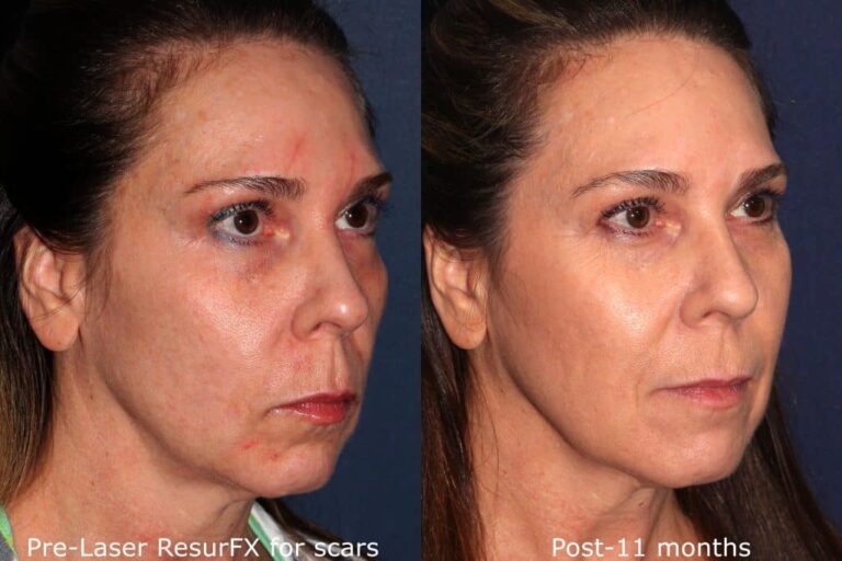 Before and after oblique image of ResurFX treatment on a female's face performed by Dr. Goldman at our San Diego med spa