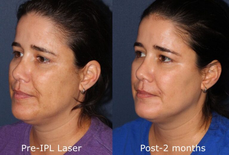 Before and after oblique image of IPL treatment on a female's face performed by Dr. Goldman at our San Diego med spa