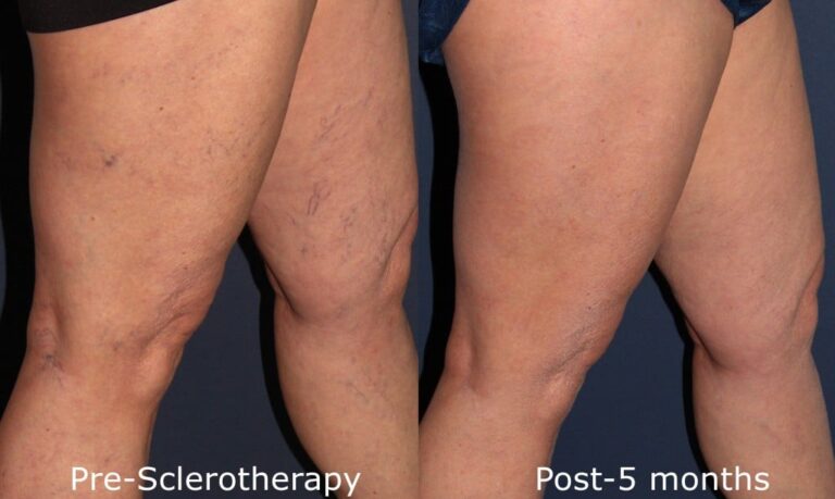 Before and after side image of sclerotherapy treatment on a female's leg veins performed by Dr. Goldman at our San Diego med spa