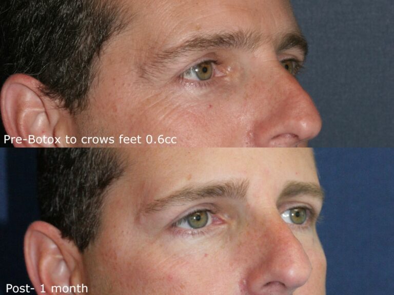 Before and after oblique image of Botox treatment on a male's crow's feet performed by Dr. Groff at our San Diego medi spa