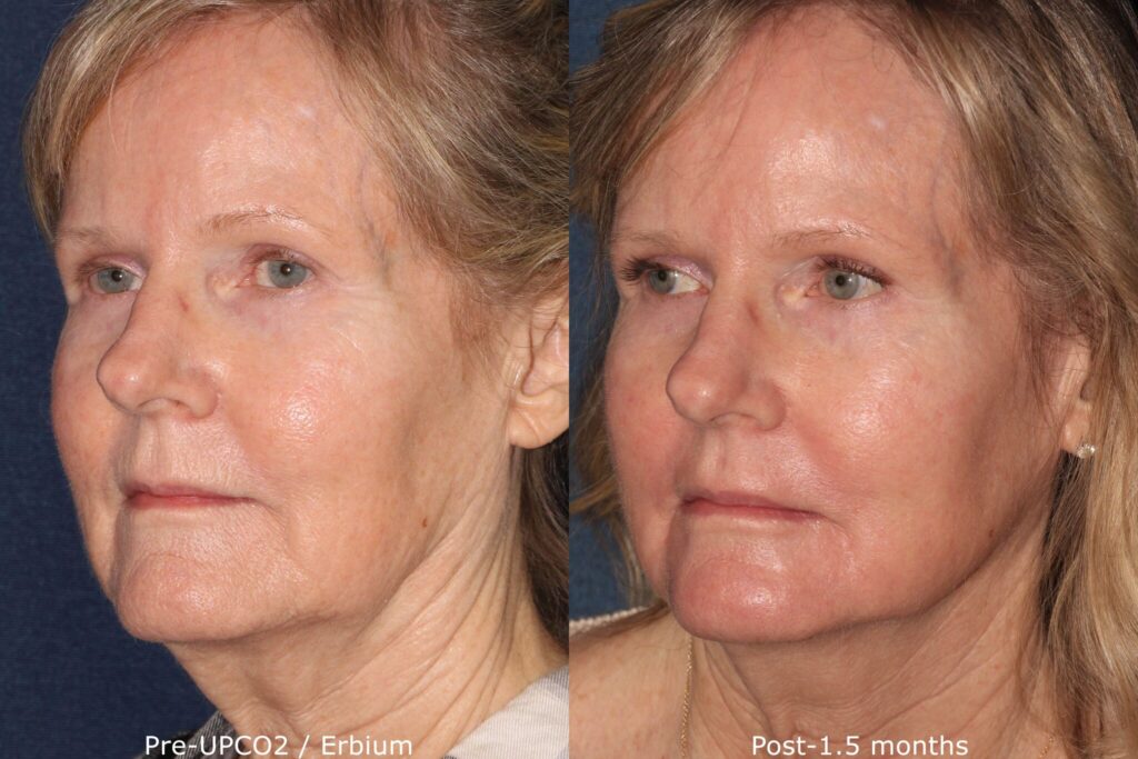 Actual un-retouched patient before and after Erbium laser treatment for fine lines and wrinkles by Dr. Groff. Disclaimer: Results may vary from patient to patient. Results are not guaranteed.