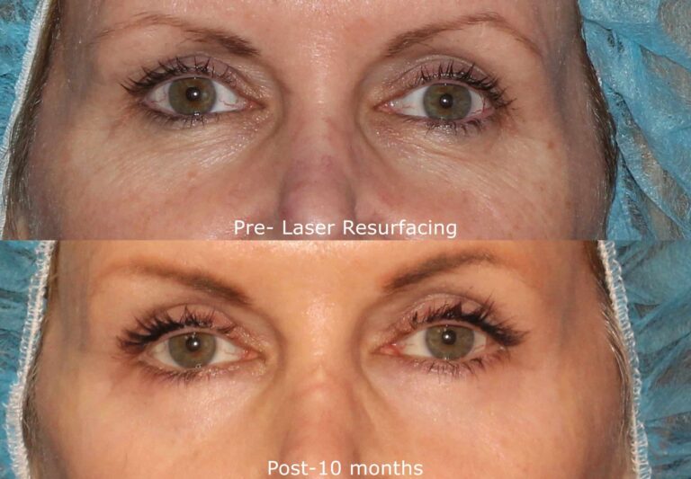 Before and after front image of laser resurfacing treatment on a female's eyes performed by Dr. Fabi at our San Diego medi spa