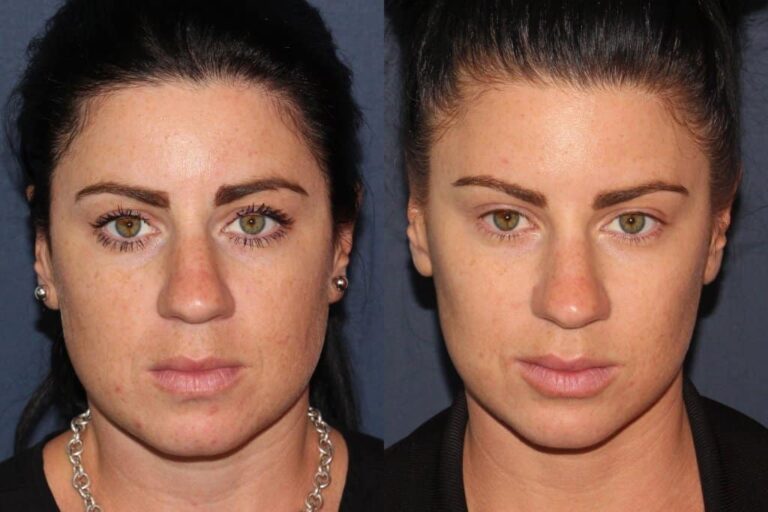 Before and after front image of Botox treatment on a female's masseter muscles performed by Dr. Fabi at our San Diego medical clinic