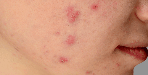 Oceanside Acne Breakout Solution