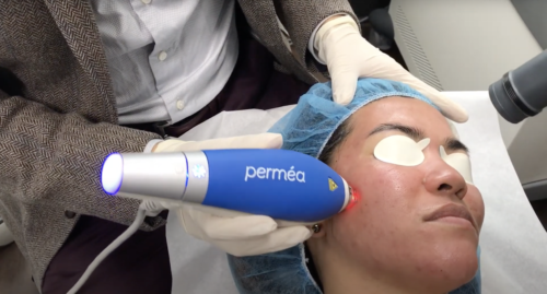 Dr. Wu is using Clear + Brilliant on his patient to treat her acne scars, San Diego, CA.