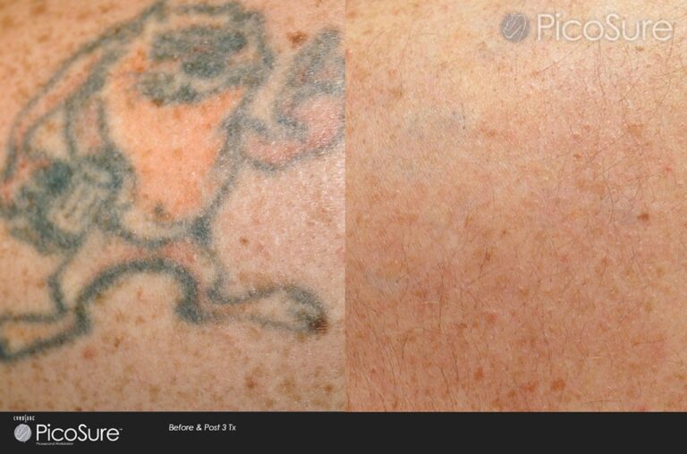 Before and After PicoSure San Diego