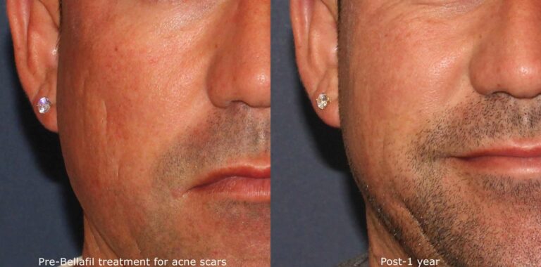 Before and after front image of Bellafill treatment on a male's midface for acne scarring performed by Dr. Wu at our San Diego medical spa