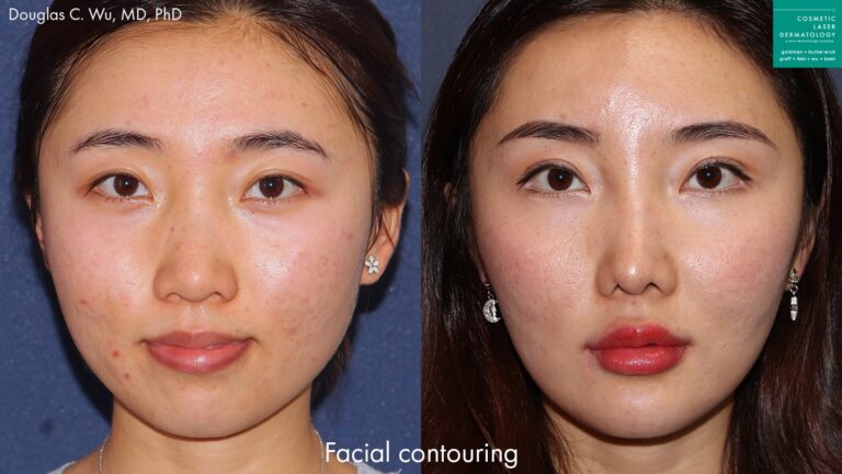 Botox and dermal fillers to contour the face by Dr. Wu. Treatment creates more narrow jawline and improves facial contour.