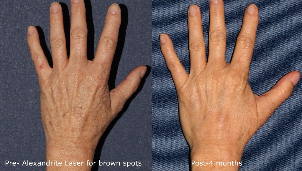 Brown Spot removal for Hands