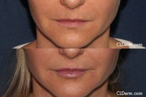 Dermal Filler Injection to the Lips Results in San Diego, CA