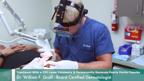 Dr. Groff is using C02 laser to treat Pearly Penile Papules, San Diego,CA.