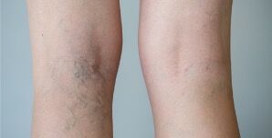 CoolTouch Varicose Vein Treatment Del mar