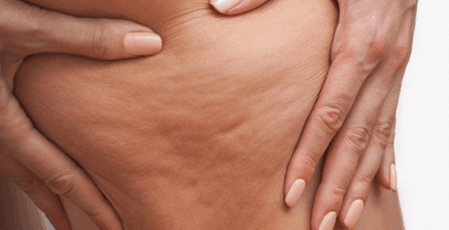 Cellulite treatment in San Diego, CA