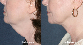 Before and after side image of CoolLipo treatment on a female's chin and neck performed by Dr. Fabi at our San Diego medical spa