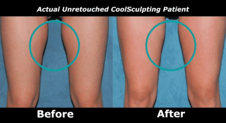 Before and after front image of CoolSculpting treatment on a female's thighs performed by Dr. Fabi at our San Diego medical clinic