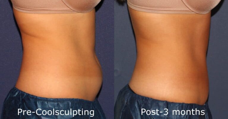Before and after side image of CoolSculpting treatment on a female's abdomen performed by Dr. Fabi at our San Diego med spa