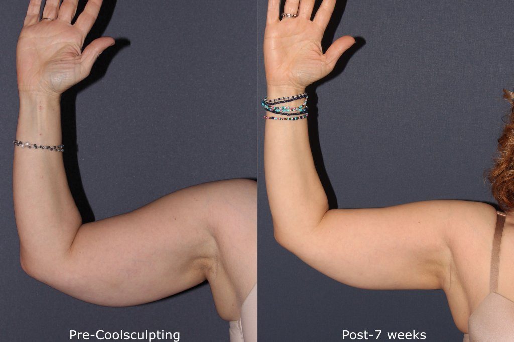 Before and after front image of CoolSculpting treatment on a female's arms performed by Dr. Goldman at our San Diego medi spa