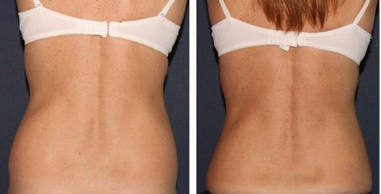 Before and after back image of CoolSculpting treatment on a female's back and flanks performed by Dr. Fabi at our San Diego medi spa