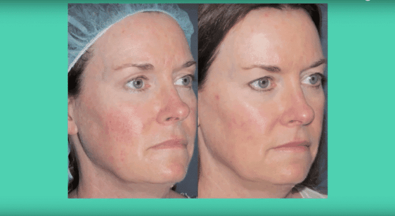 Before and after ablique image of IPL treatment on a female's facial redness performed by Dr. Fabi at our San Diego medical spa