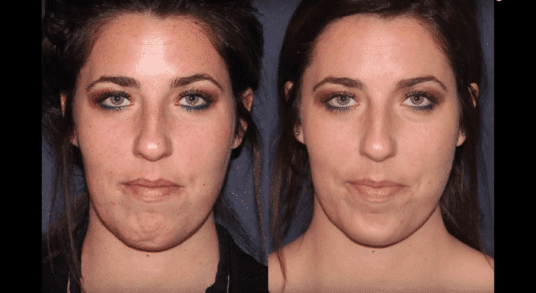 Before and after front image of IPL treatment on a female's face performed by Dr. Wu at our San Diego medical spa