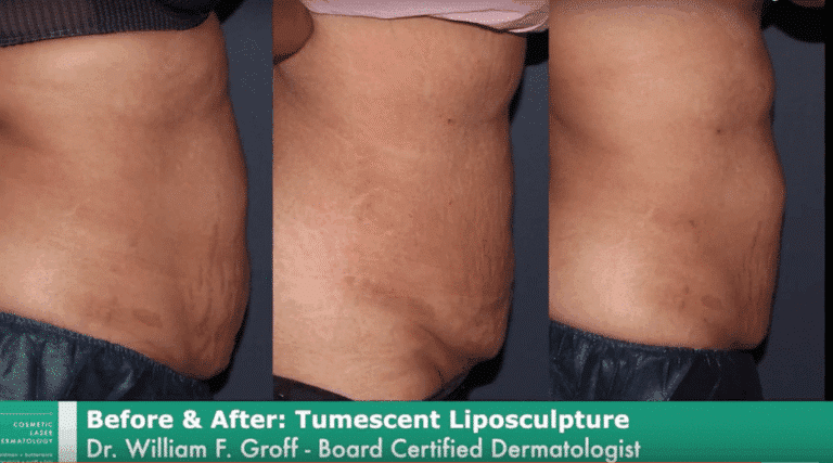 Before and after side image of liposculpture treatment on a female's abdomen performed by Dr. Groff at our San Diego medical clinic