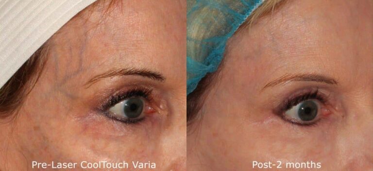 Before and after oblique image of CoolTouch Varia treatment on a female's veins around the eyes performed by Dr. Fabi at our San Diego medical spa