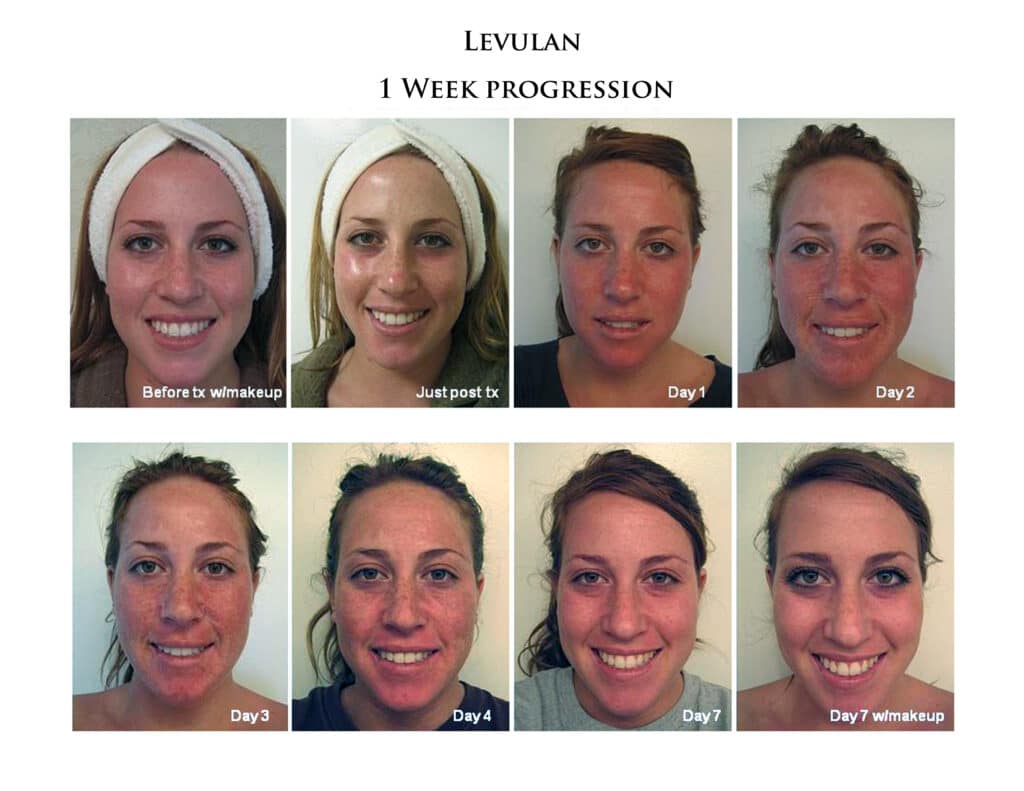 Photodynamic Therapy PDT San Diego CA Cosmetic Laser Dermatology