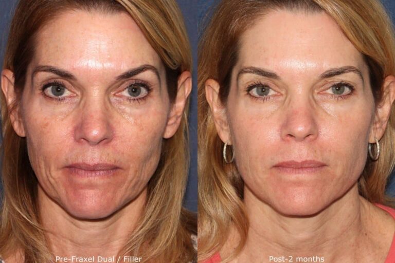 Before and after front image of Fraxel laser and injectable treatment on a female's facial lines performed by Dr. Wu at our San Diego medical spa
