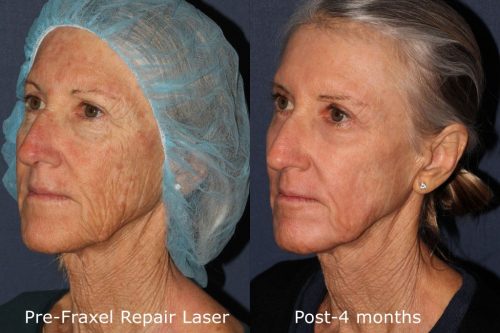 laser resurfacing anti aging treatment la jolla