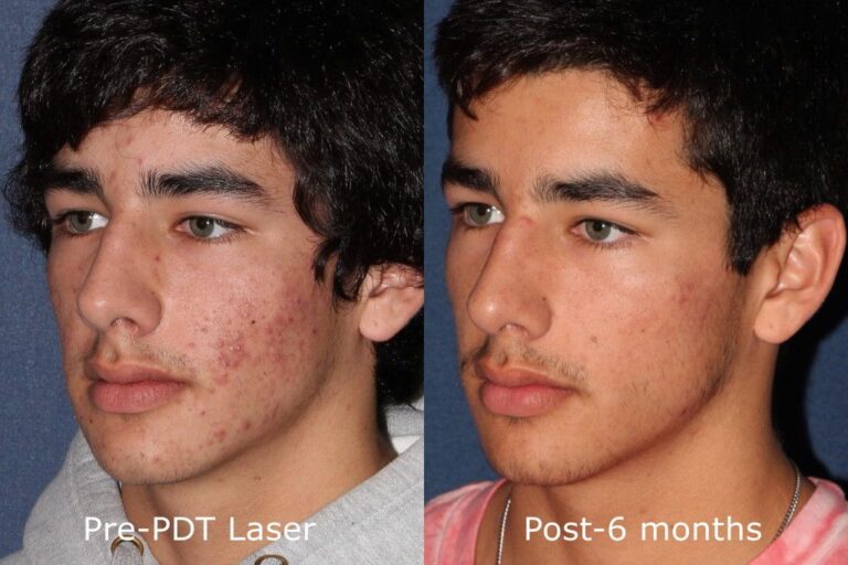 Before and after oblique image of photodynamic therapy on a male's face performed by Dr. Goldman at our San Diego medical clinic