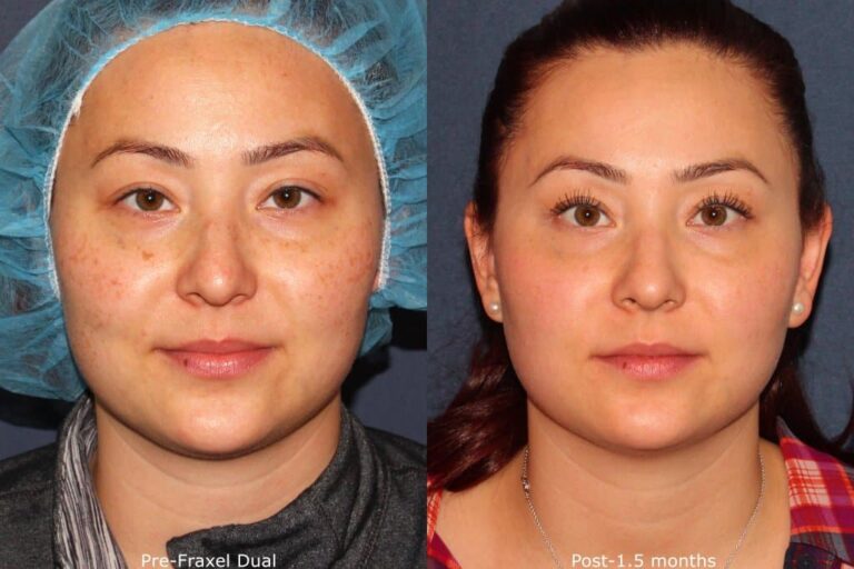 Before and after front image of Fraxel Dual laser treatment on a female's face performed by Dr. Groff at our San Diego medical spa