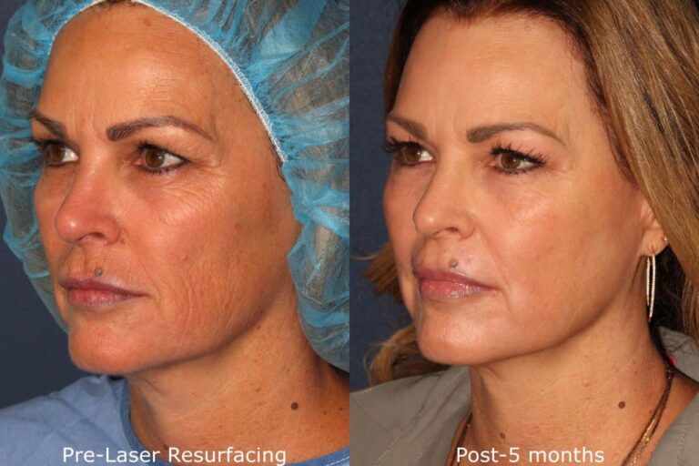 Before and after oblique image of laser resurfacing treatment on a female's face performed by Dr. Groff at our San Diego medical spa