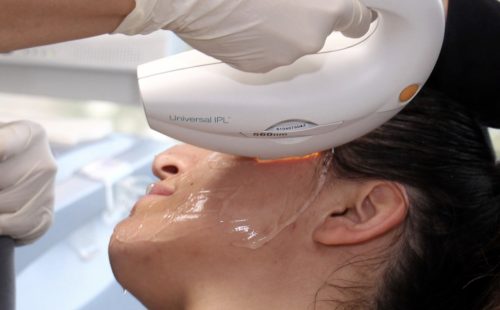 A woman is receiving an IPL Photo facial treatment, San Diego, CA.