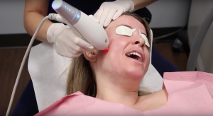 dermatologist applying ipl laser