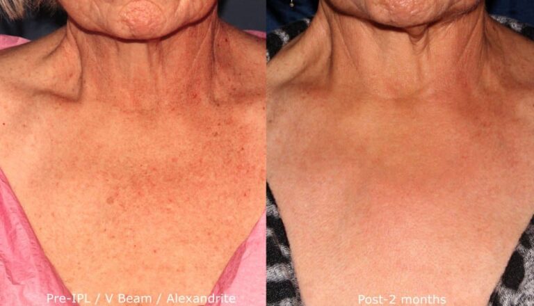 Before and after front image of IPL, Vbeam, and Alexandrite treatment on a female's chest performed by Dr. Groff at our San Diego med spa