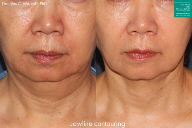 ThermiTight for neck and jawline contouring by Dr. Wu. Treatment tightens up sagging skin to restore definition to the jawline.