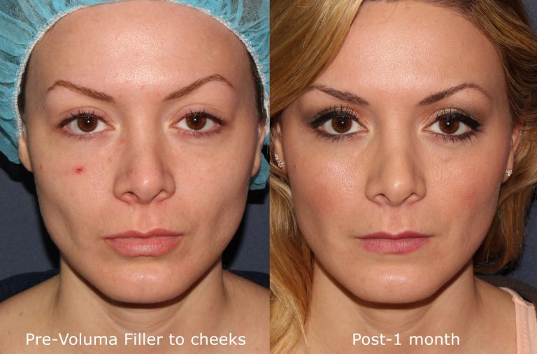 A Biased View of Juvederm - Christopher Jones, Md thumbnail