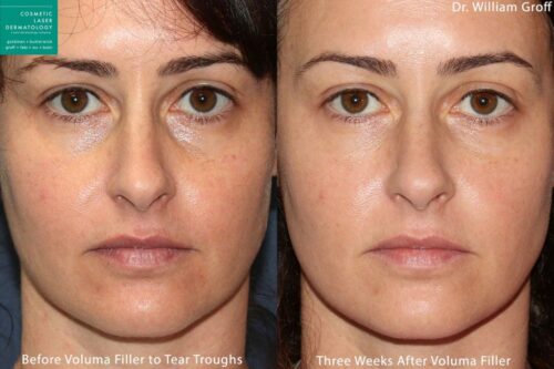 Volume Treatment Injection - Cosmetic Laser Dermatology Skin Specialists in  San Diego