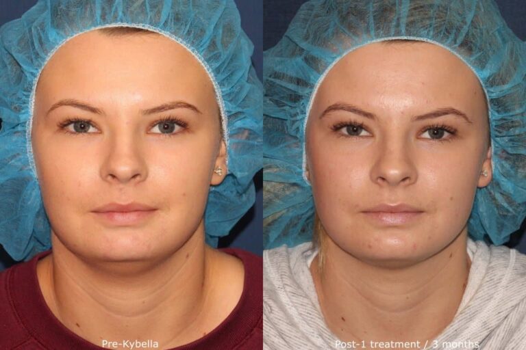 Before and after front image of Kybella treatment on a female's submental fat performed by Dr. Fabi at our San Diego med spa