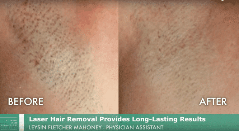 Before and after front image of laser hair removal treatment on a patient's underarm performed by Leysin Fletcher, PA-C, at our San Diego medical clinic