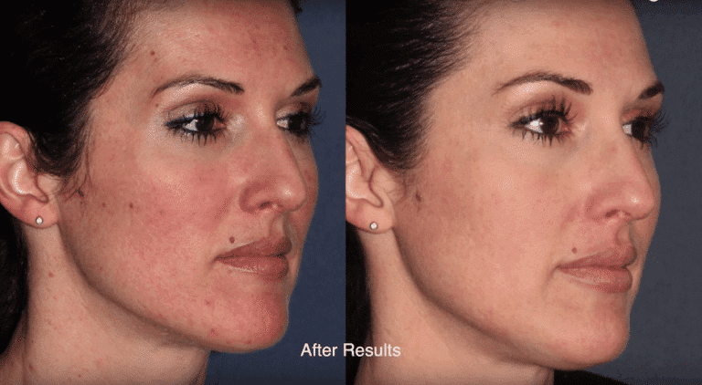 Before and after oblique image of ResurFX on a female's face performed by Dr. Goldman at our San Diego medical clinic